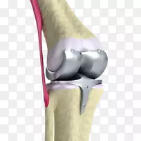 人工膝关节置换术-膝关节骨关节炎