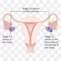 卵巢癌分期卵巢癌研究英国
