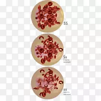 共显性镰刀细胞病镰刀细胞性状遗传病