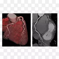 冠状动脉ct造影冠状动脉插管计算机体层摄影术心脏