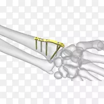 拇指桡骨远端骨折桡骨茎突尺侧茎突.桡骨茎突