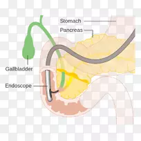 内镜逆行胰胆管造影术内镜胆道造影胆管原发性硬化性胆管炎