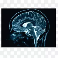 人脑x光颅脑损伤医学-脑