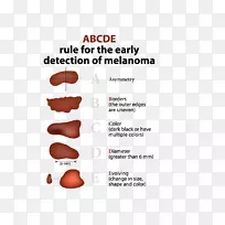 黑色素瘤皮肤癌基底细胞癌