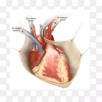 冠状动脉旁路手术血管旁路非体外循环冠状动脉搭桥术冠心病-心脏
