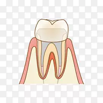 歯科牙医根管治疗蛀牙-牙髓疗法