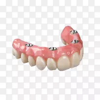 牙科种植义齿，可摘局部义齿，牙科义齿.桥