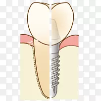 牙科歯科牙科植入物治疗义齿.桥