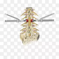 脊柱截骨术后凸症腰椎减影术