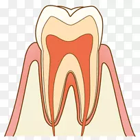 歯科牙医牙刷蛀牙疗法-牙洞