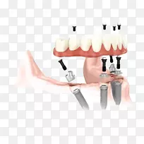 牙种植体基牙科义齿冠