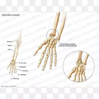 腕骨骨折腕骨梨形骨