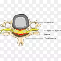 颈椎病颈脊髓