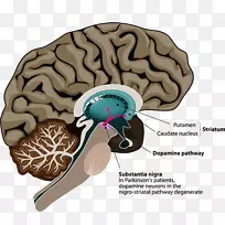 帕金森病深部脑刺激神经成像-脑
