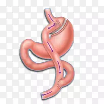 Roux-en-y吻合术胃旁路手术减肥手术袖状胃切除术胃旁路手术