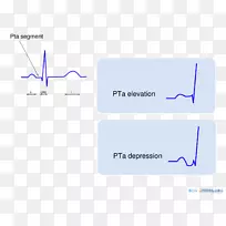 P波心电图QRs复杂窦性心律