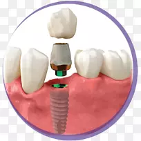 牙种植体冠基-植入牙