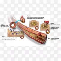 动脉硬化低密度脂蛋白泡沫细胞动脉瘤心血管疾病
