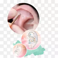 耳廓耳穴疗法