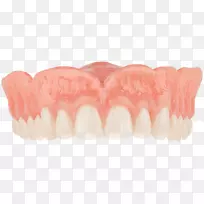 牙科可摘局部义齿冠