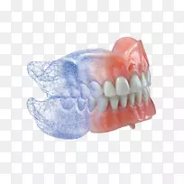 牙科实验室牙种植体发光义齿