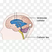 脑分流内镜下第三脑室造口术脑积水脑脊液