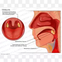 扁桃体炎，耳鼻喉科，咽炎，口咽喉癌-鼻