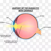 浅眼晶状体强度训练解剖性白内障-光