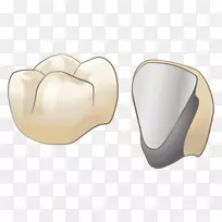 審美歯科牙医オールセラミック治疗-牙冠