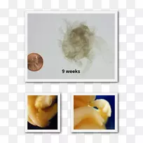 颌骨婴儿-流产