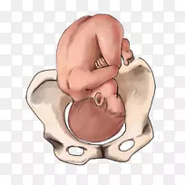 胎位分娩，婴儿臀位分娩-妊娠