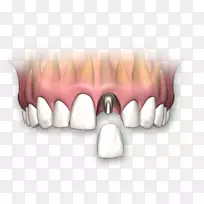 牙种植义齿牙科冠人牙种植体