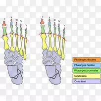 莫顿趾，莫顿神经瘤，足跖骨