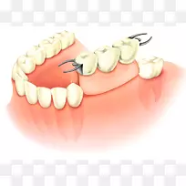牙义齿，牙种植体假体，牙科.桥