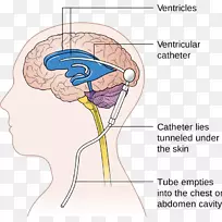 脑分流神经外科脑积水脑脊液脑