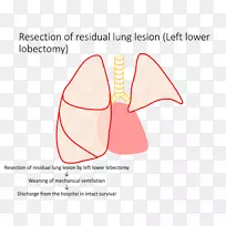先天性肺气道畸形肺叶切除术肺Aventura肺研究所
