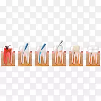 牙科牙髓治疗牙髓学-橙色