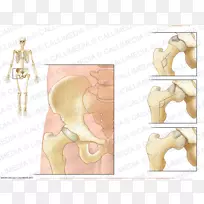 髋关节关节炎、股骨大转子、小转子-rán 3d