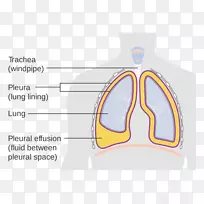 ICD-10胸腔积液肺