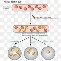 Ashby技术血液学红血球献血-血液