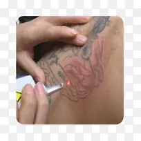 美甲纹身摘除术.指甲