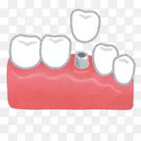 牙科种植体治疗假牙.牙种植体