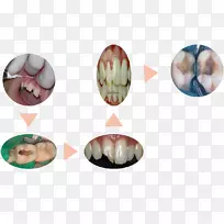 牙髓根管治疗牙髓