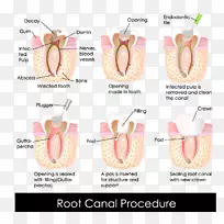 牙髓治疗根管牙科冠