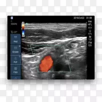 医学影像颈动脉超声多普勒超声心动图血流