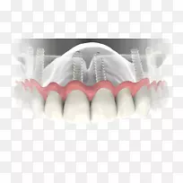 牙科种植义齿.牙科植入物