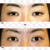 眉毛眼睑扩张术