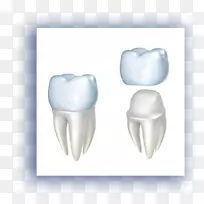 牙科修复牙种植体-受损牙