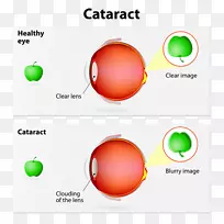 白内障手术人工晶状体人眼