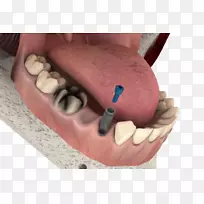牙种植体牙科治疗牙种植桥
